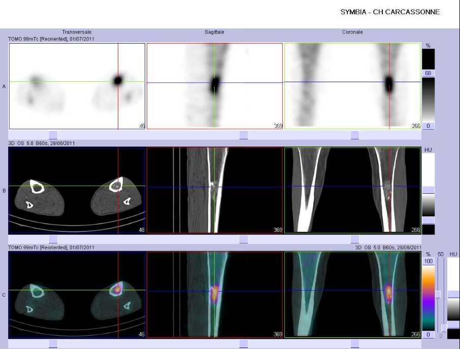 Probable enchondrome du tibia gauche