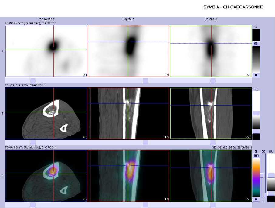 Probable enchondrome du tibia gauche
