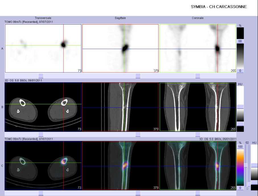 Fracture de fatigue du tiers moyen du tibia gauche