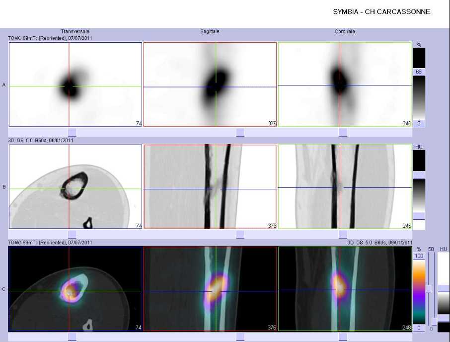 Fracture de fatigue du tiers moyen du tibia gauche
