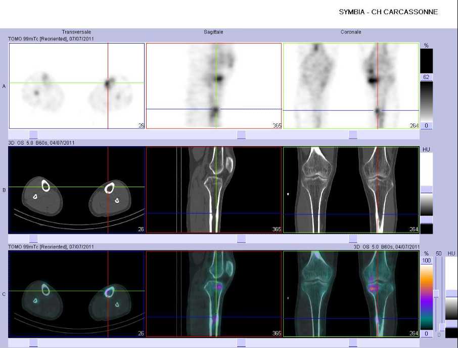 Gu&eacute;rison de la fracture de fatigue du tiers sup&eacute;rieur de la diaphyse tibiale gauche