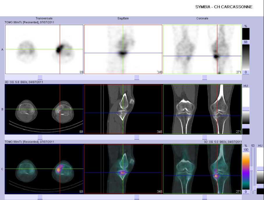 Fracture de fatigue de l'&eacute;piphyse sup&eacute;rieure du tibia gauche, en dessous du plateau tibial m&eacute;dial