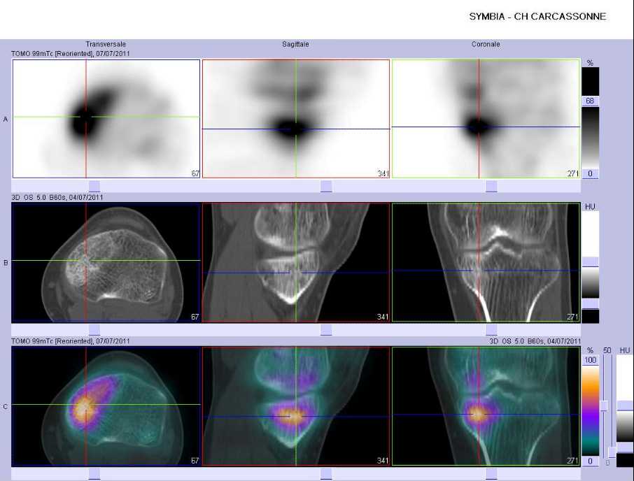 Fracture de fatigue de l'&eacute;piphyse sup&eacute;rieure du tibia gauche, en dessous du plateau tibial m&eacute;dial