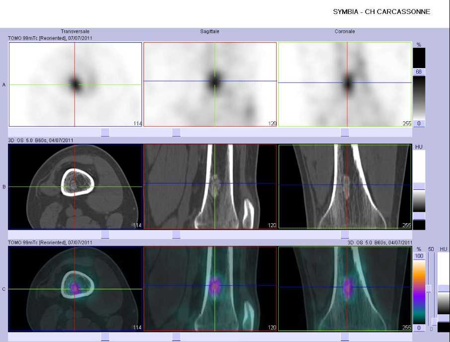 L&eacute;sion osseuse b&eacute;nigne de la m&eacute;taphyse inf&eacute;rieure du f&eacute;mur gauche, &eacute;voquant un infarctus osseux