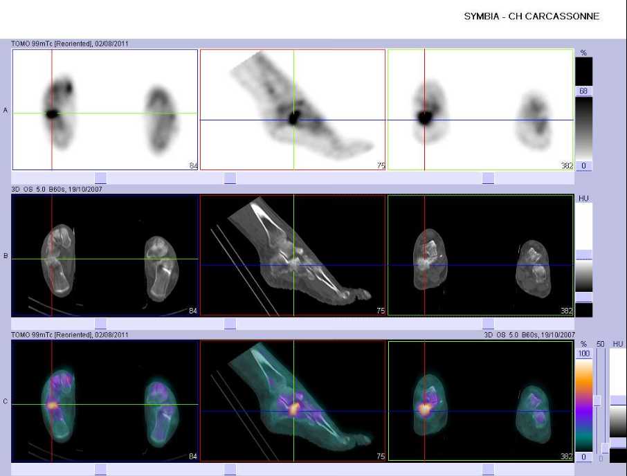 Fracture par insuffisance osseuse du calcaneus droit