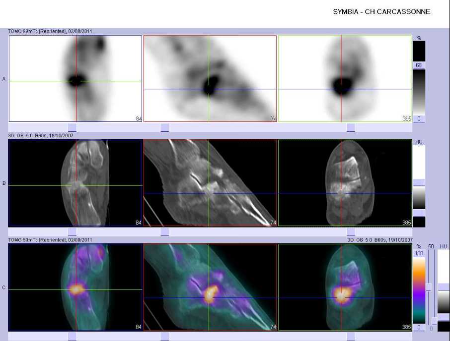 Fracture par insuffisance osseuse du calcaneus droit
