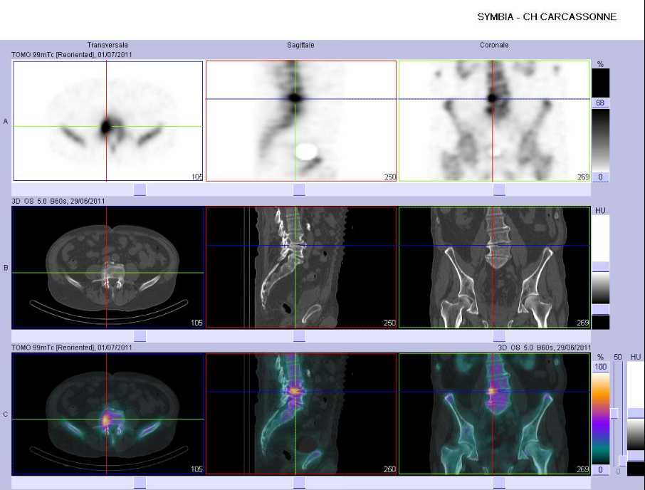 Discopathie arthrosique L4/L5