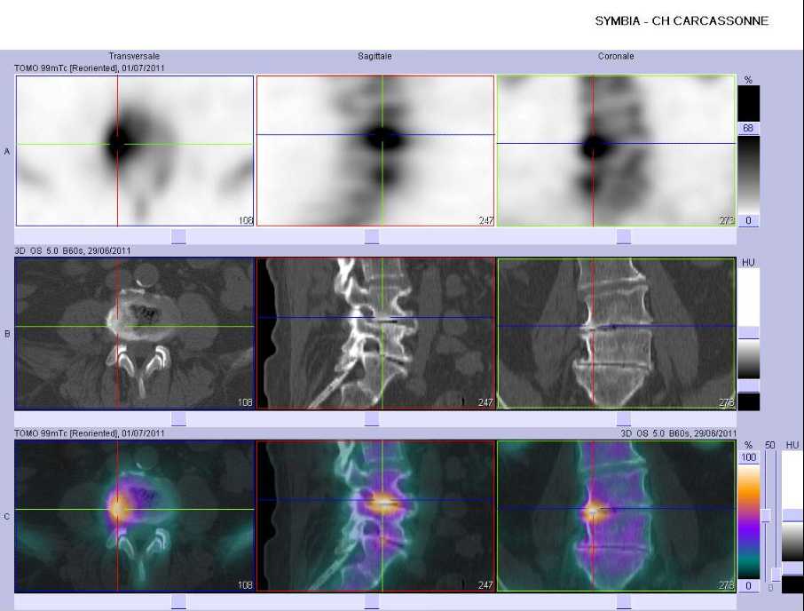 Discopathie arthrosique L4/L5