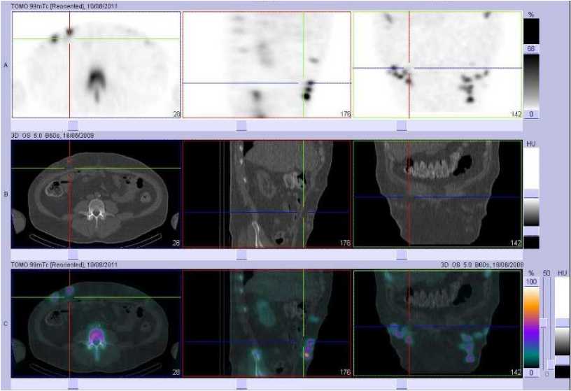 Multiples h&eacute;matomes de la paroi abdominale ant&eacute;rieure