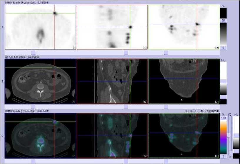 Multiples h&eacute;matomes de la paroi abdominale ant&eacute;rieure