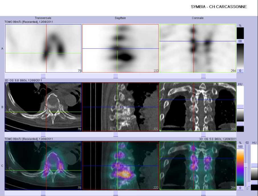 Multiples fractures de c&ocirc;tes