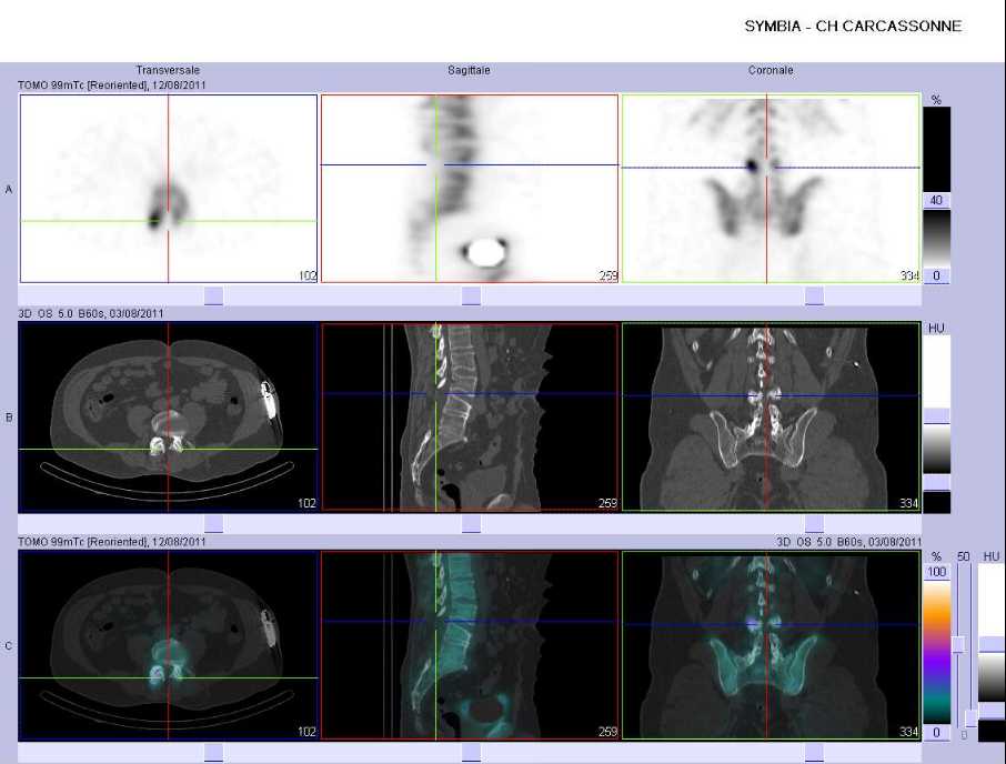 Arthrose des articulaires post&eacute;rieures et s&eacute;quelles de laminectomie post&eacute;rieure lombaire