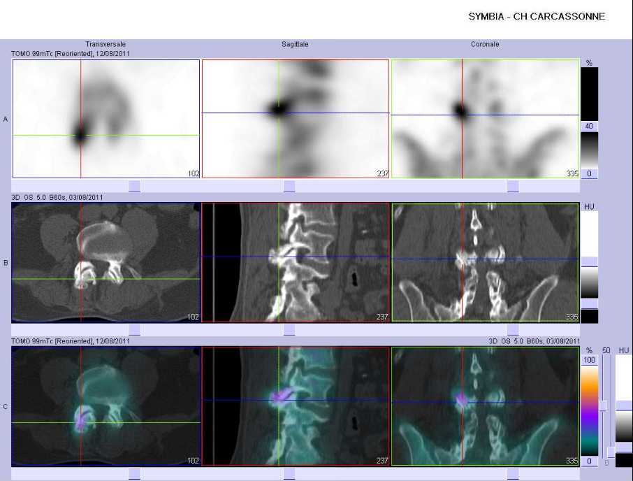 Arthrose des articulaires post&eacute;rieures et s&eacute;quelles de laminectomie post&eacute;rieure lombaire