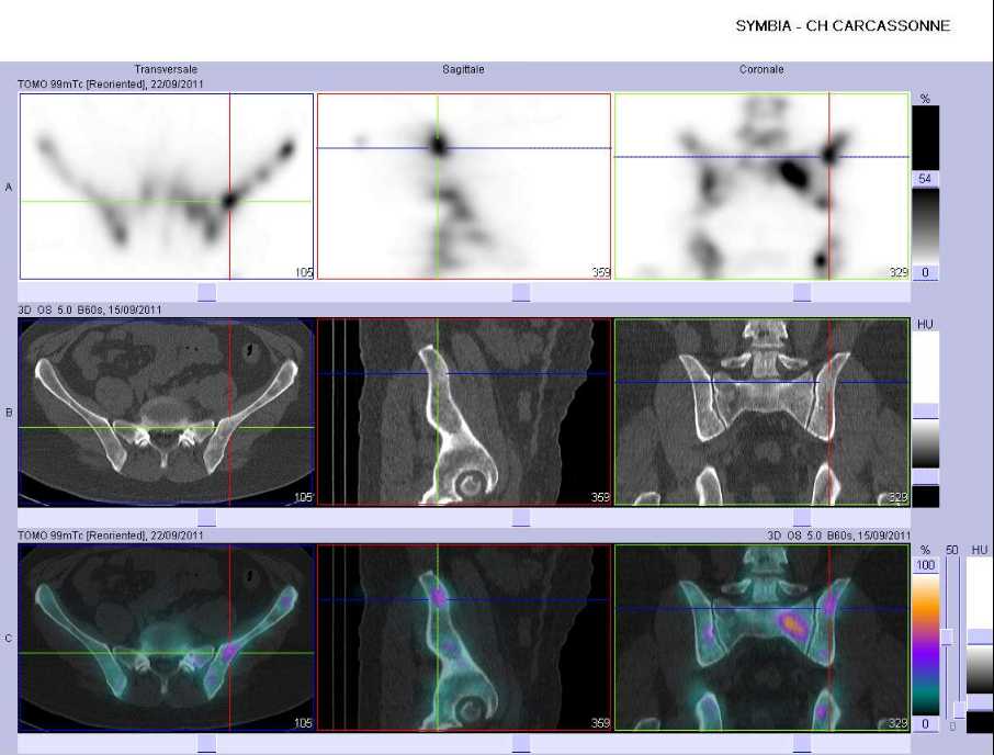 Multiples m&eacute;tastases ost&eacute;ocondensantes de l'aile iliaque gauche
