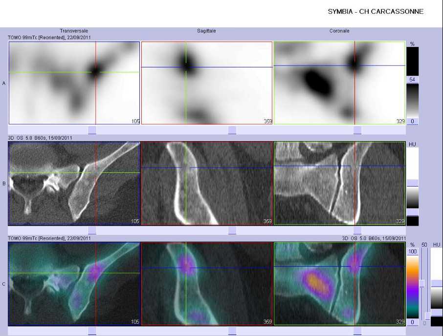 Multiples m&eacute;tastases ost&eacute;ocondensantes de l'aile iliaque gauche