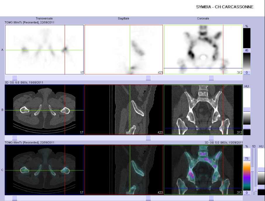 Multiples m&eacute;tastases ost&eacute;ocondensantes de l'extr&eacute;mit&eacute; sup&eacute;rieure du f&eacute;mur gauche