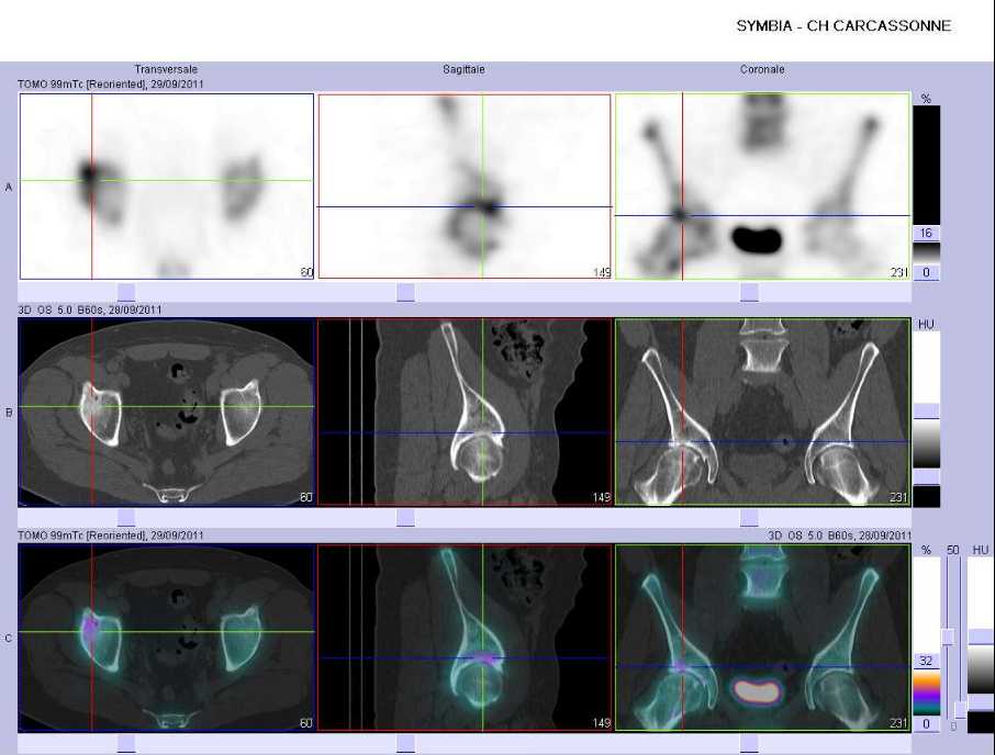 Coxarthrose droite