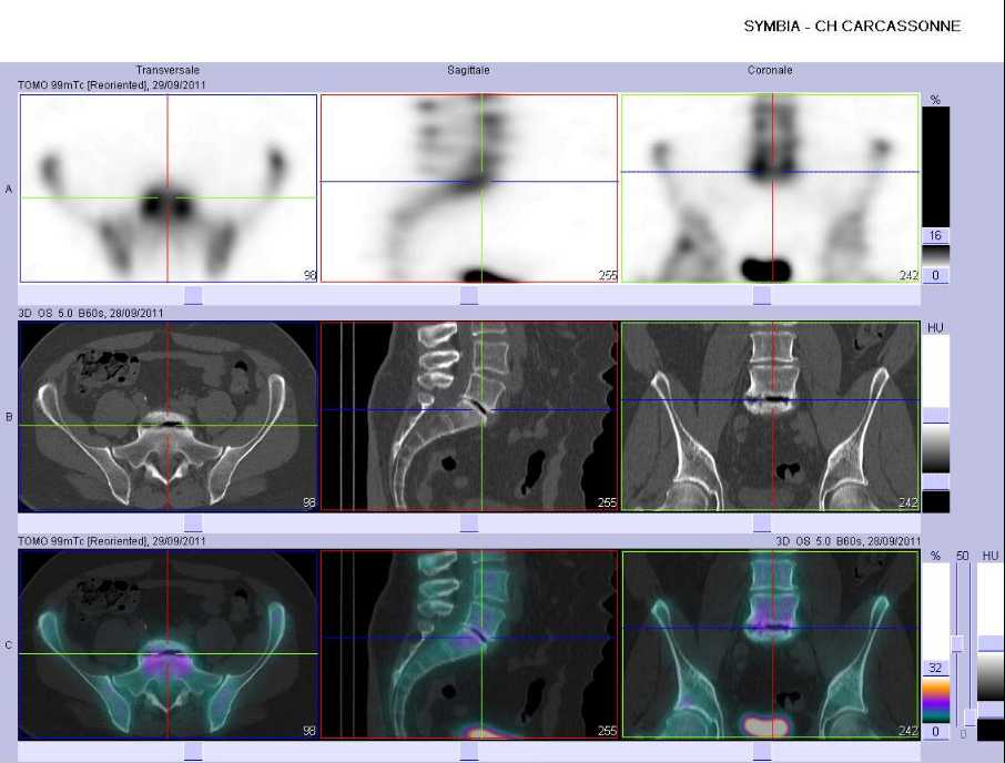 Discopathie arthrosique L5/S1