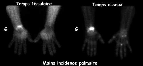 Mains - Incidence palmaire