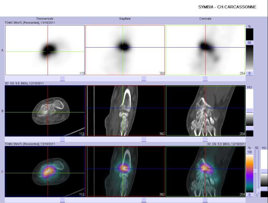 Fracture de l'extr&eacute;mit&eacute; inf&eacute;rieure du radius gauche
