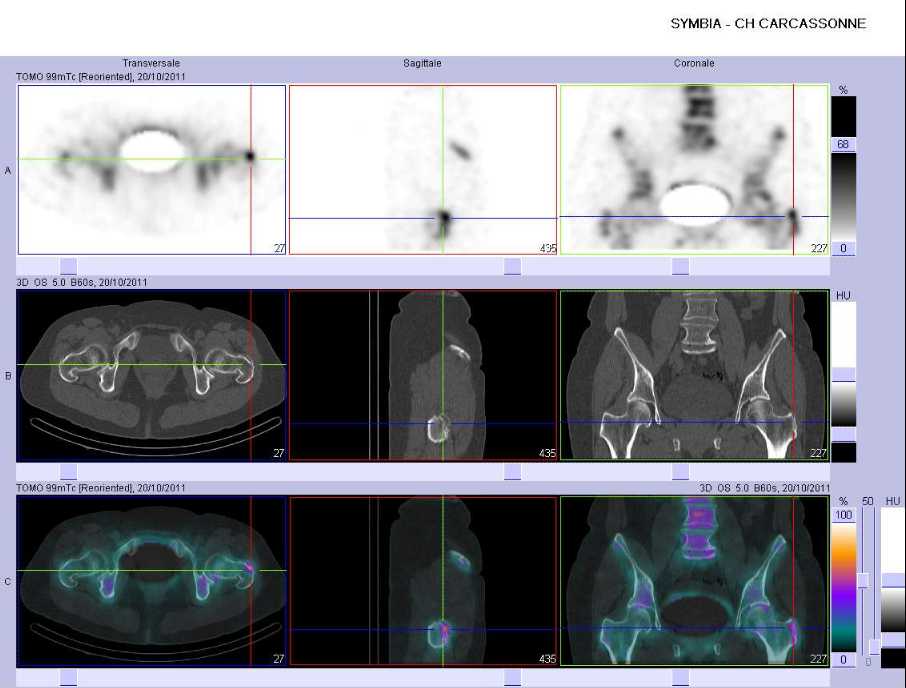 Pathologie d'insertion du grand trochanter gauche