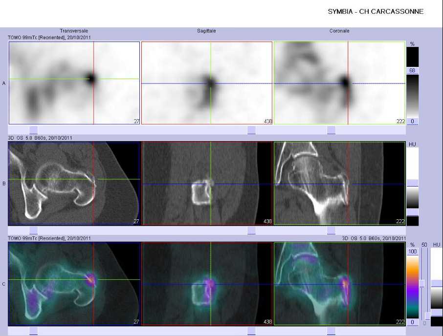 Pathologie d'insertion du grand trochanter gauche