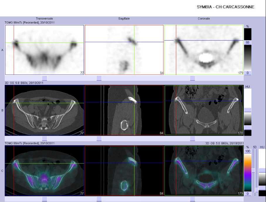Pathologie d'insertion bilat&eacute;rale des cr&ecirc;tes iliaques