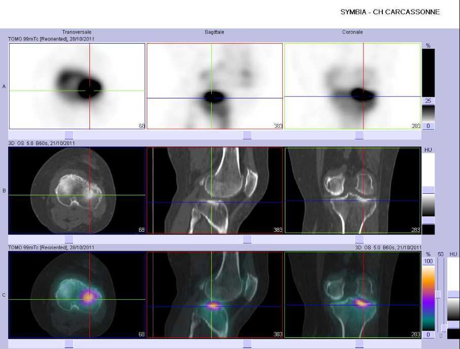 Fracture par insuffisance osseuse du plateau tibial lat&eacute;ral gauche