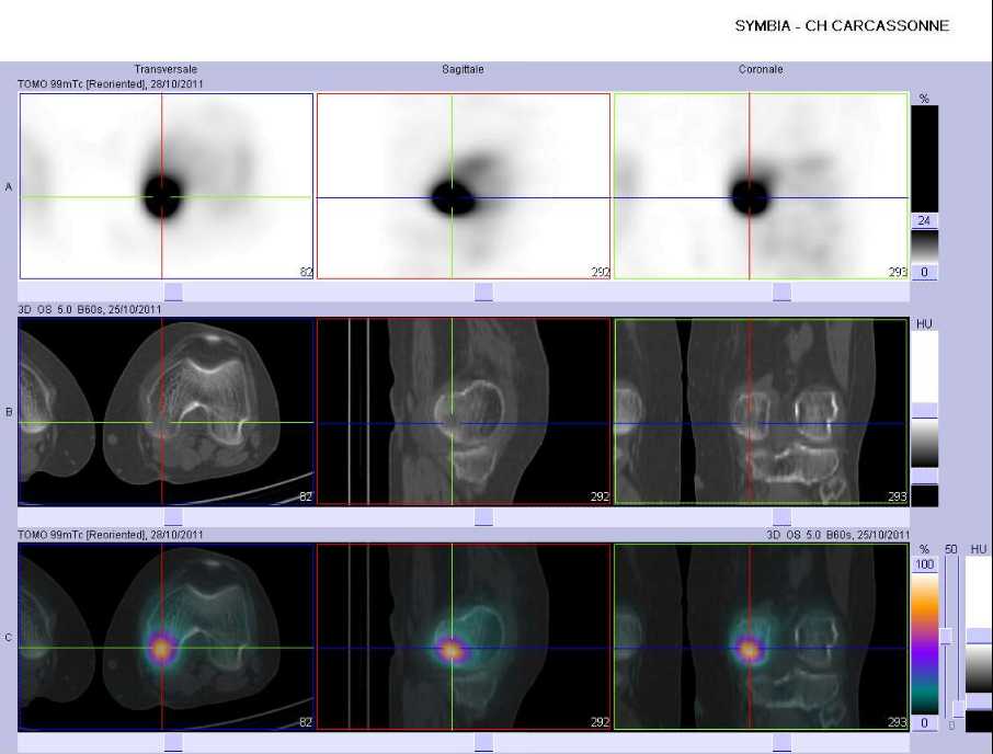 Fracture sous-chondrale du condyle f&eacute;moral m&eacute;dial  gauche
