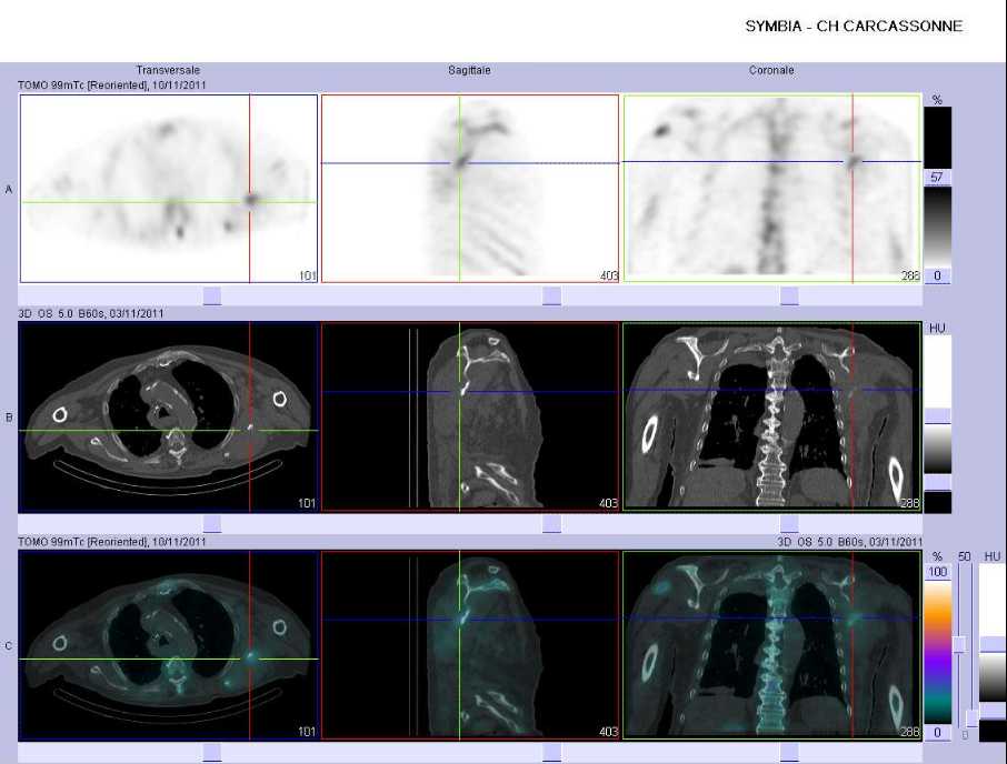 Volumineuse m&eacute;tastase lytique de l'omoplate gauche &eacute;tendue aux masses musculaires adjacentes