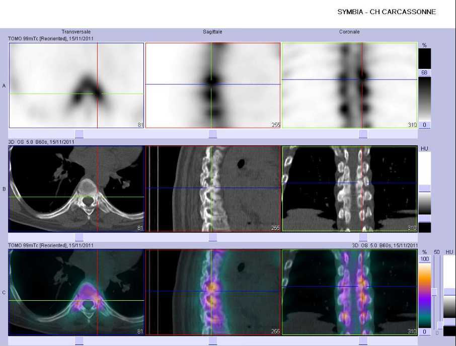Atteinte inflammatoire des articulations costo-vert&eacute;brales