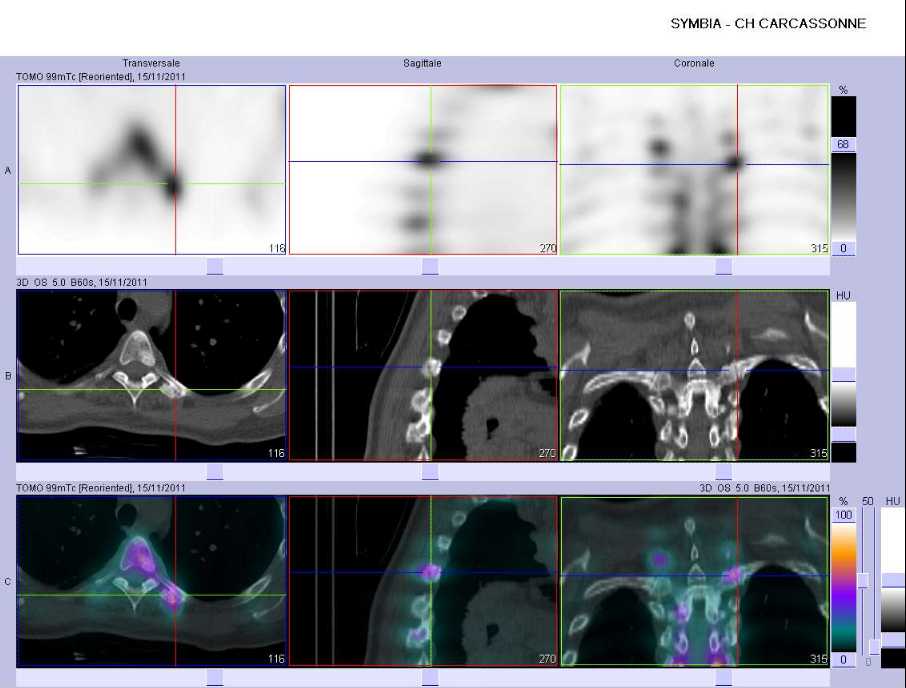 Atteinte inflammatoire des articulations costo-transversaires