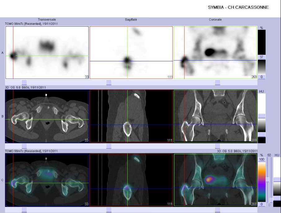 Tendinopathie inflammatoire du tubercule majeur de l'hum&eacute;rus droit et du f&eacute;mur droit