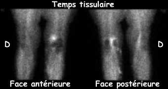 Genoux - Temps tissulaire