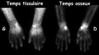 Mains - Temps tissulaire et temps osseux