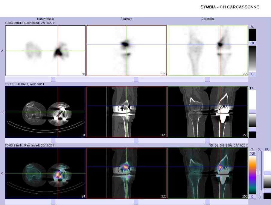 Fracture par insuffisance osseuse du condyle f&eacute;moral m&eacute;dial gauche