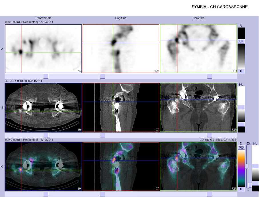 Calcifications p&eacute;riproth&eacute;tiques droites