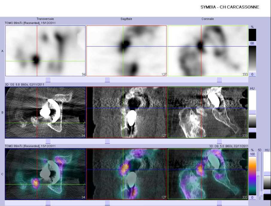 Calcifications p&eacute;riproth&eacute;tiques droites