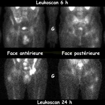 Leukoscan