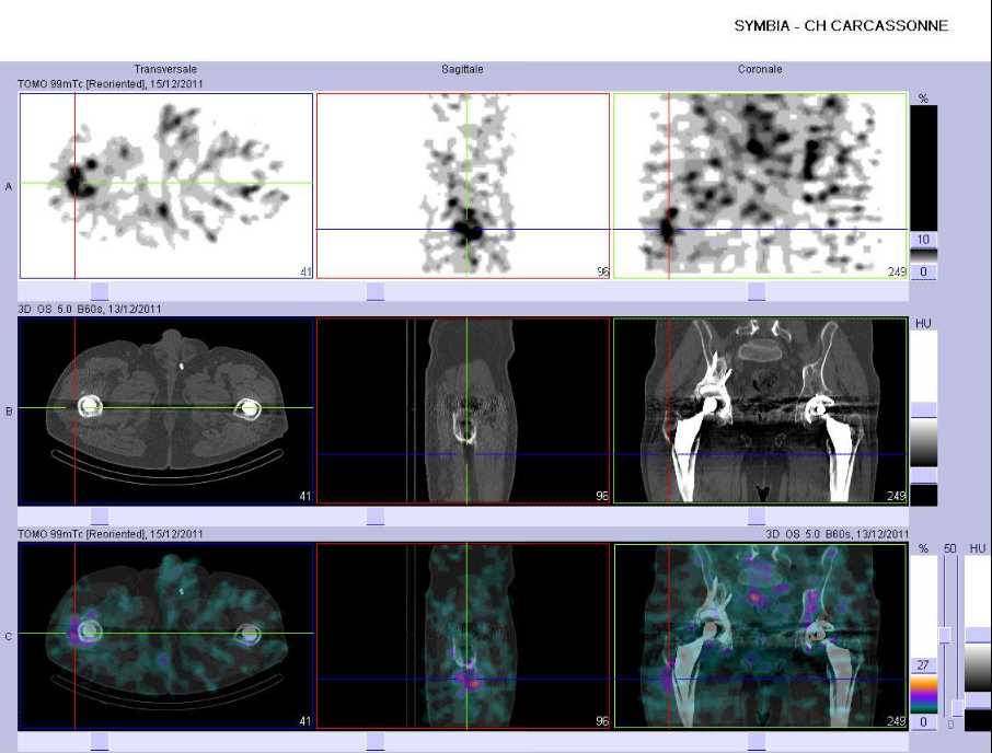 Fixation du Leukoscan en regard de l'extr&eacute;mit&eacute; sup&eacute;rieure du f&eacute;mur droit