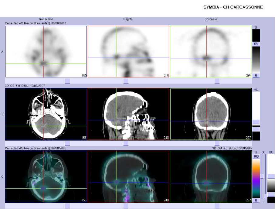 Fixation au sein d'une m&eacute;tastase intra-cranienne