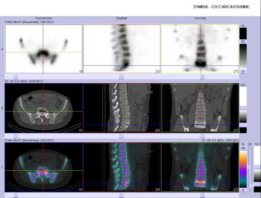 Discopathie arthrosique L5-S