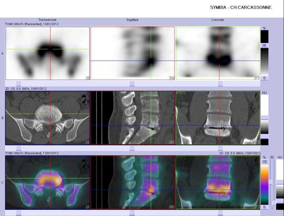 Discopathie arthrosique L5-S