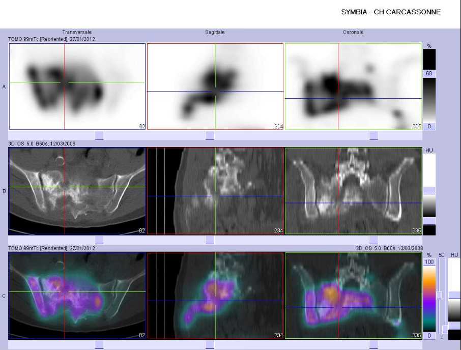 Multiples m&eacute;tastases ost&eacute;ocondensantes du bassin 