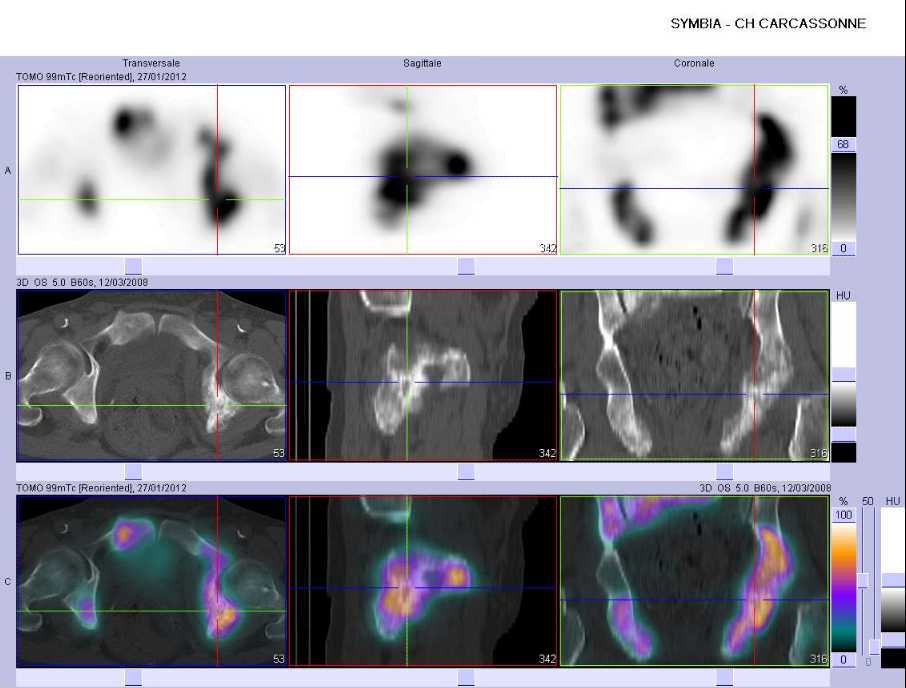 Multiples m&eacute;tastases ost&eacute;ocondensantes du bassin 