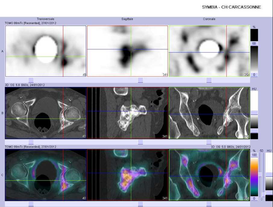 Multiples m&eacute;tastases osseuses ost&eacute;ocondensantes du bassin