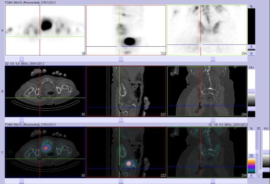 Collection &eacute;tendue dans la fesse droite en rapport avec une fistule de la face lat&eacute;rale droite du rectum