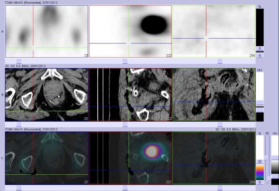 Collection &eacute;tendue dans la fesse droite en rapport avec une fistule de la face lat&eacute;rale droite du rectum