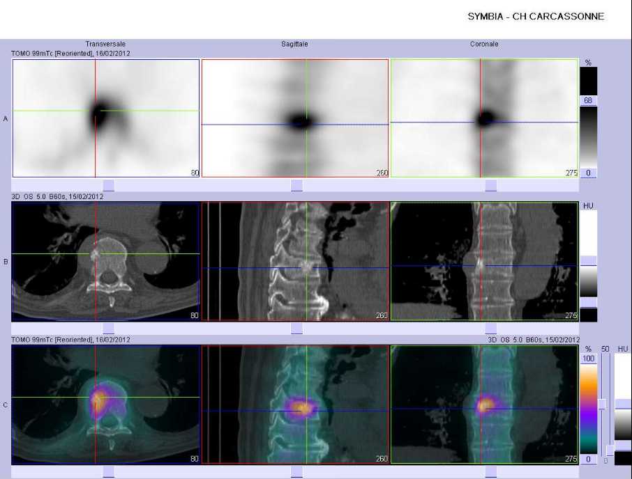 Tassement vert&eacute;bral pathologique de T8