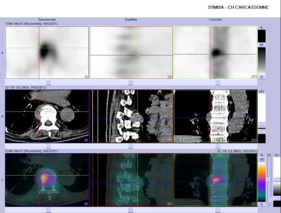 Tassement vert&eacute;bral pathologique de T8